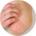 Psoriáza (lupénka)