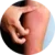 Ekzém