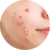 Akné