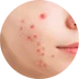 Akné