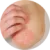 Psoriáza (lupénka)