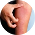 Ekzém