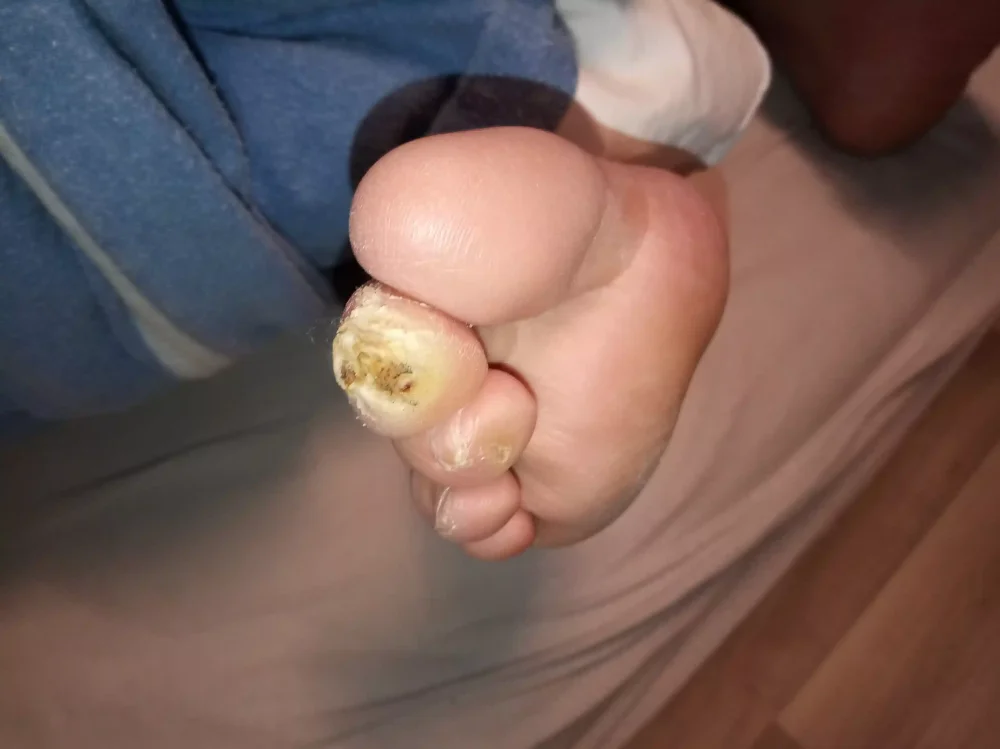 Diabetická noha fotka. Jak vypadá diabetická noha?