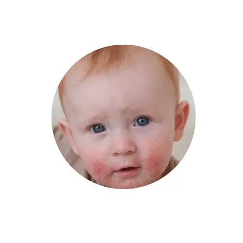 Dermatitidy u dětí.
